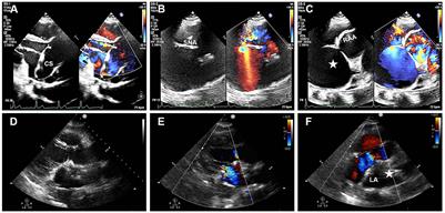 Case report: Ruptured aortic sinus aneurysm with left coronary artery aneurysm-right atrial fistula